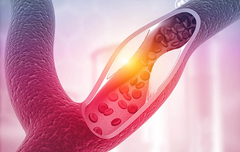 Антифосфолипидный синдром: симптомы, диагностика, лечение