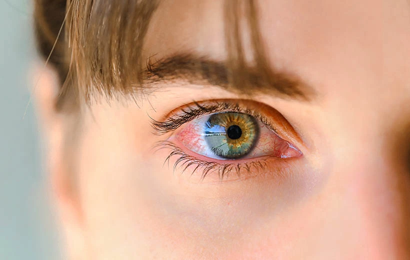 Дакриоцистит: симптомы и лечение