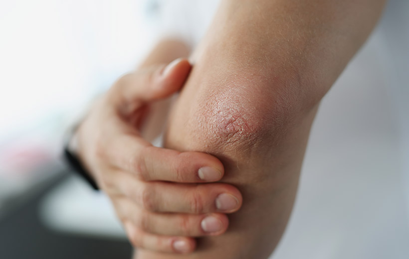 Шелушение кожи: причины, симптомы, лечение Шелушение кожи: причины, симптомы, лечение