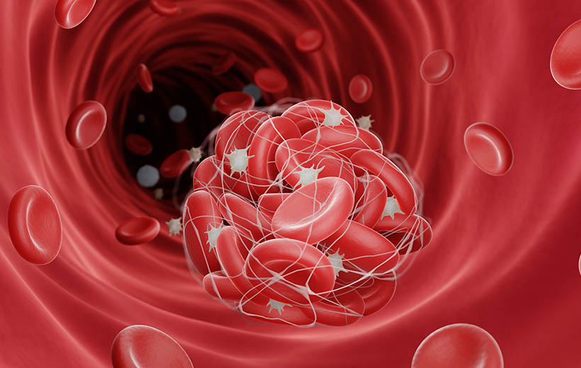 Тромбоцитопеническая пурпура: симптомы и лечение Тромбоцитопеническая пурпура: симптомы и лечение