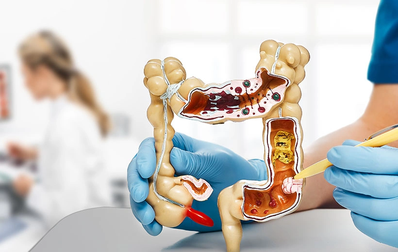 Язвенный колит: симптомы, лечение, диета