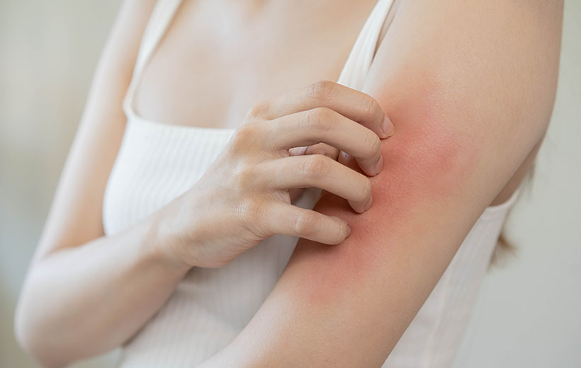 Потница: симптомы и лечение Потница: симптомы и лечение