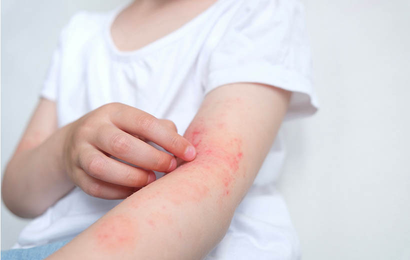 Дерматоз: причины, симптомы, лечение