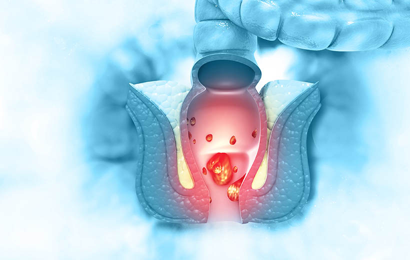 Анальный зуд: причины и лечение