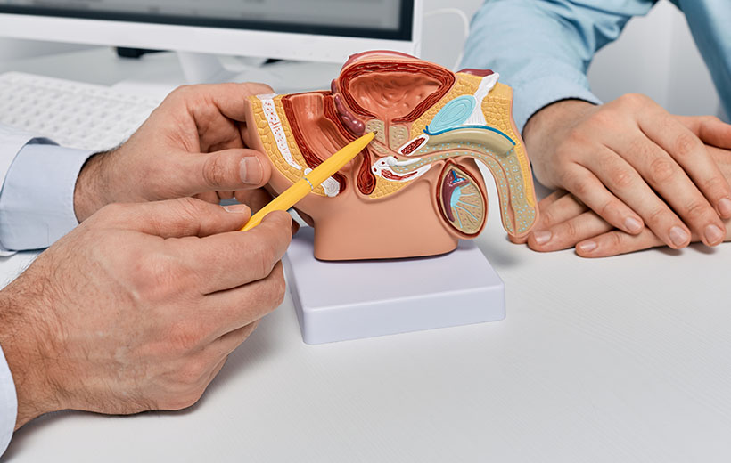 Рак простаты: стадии, симптомы, лечение, прогноз