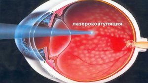 Лазерная коагуляция сетчатки: основные аспекты и применение