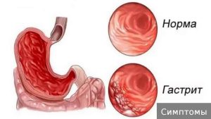 Хронический гастрит: причины, симптомы и методы лечения