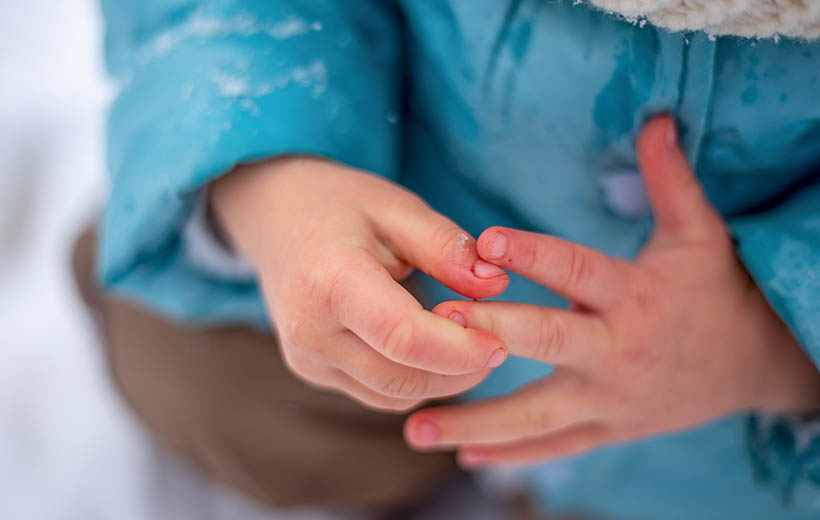 Обморожение: степени и первая помощь Обморожение: степени и первая помощь