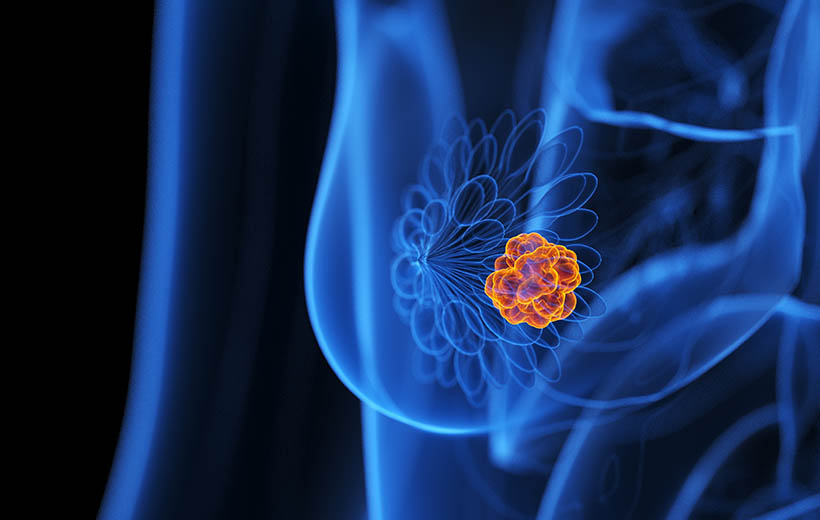 Опухоли молочных желез: стадии, симптомы, лечение Опухоли молочных желез: стадии, симптомы, лечение