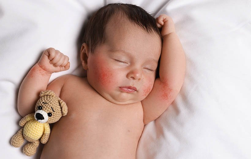 Болезнь Кавасаки: симптомы и лечение