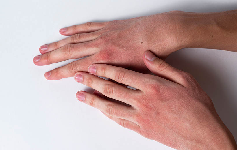 Болезнь Бехчета: симптомы и лечение Болезнь Бехчета: симптомы и лечение