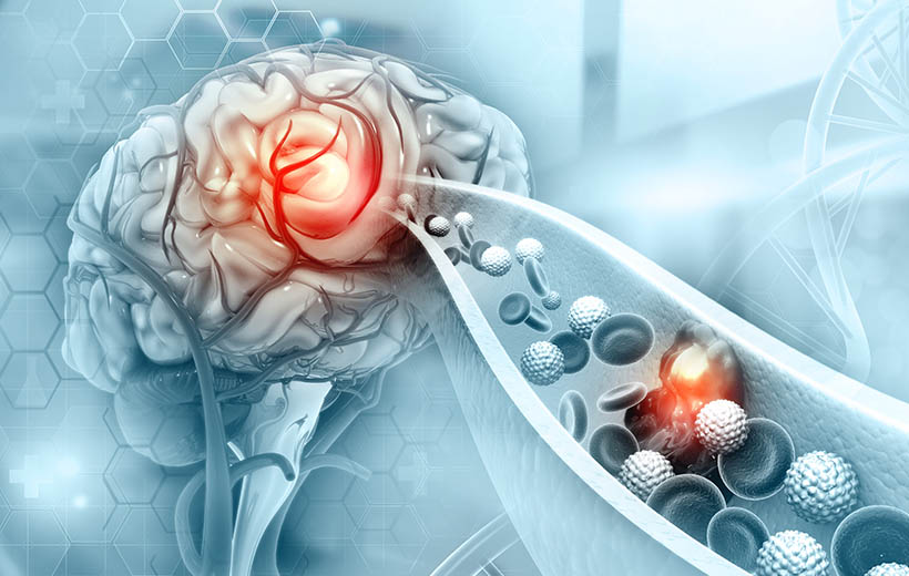Флегмона: симптомы и лечение Флегмона: симптомы и лечение
