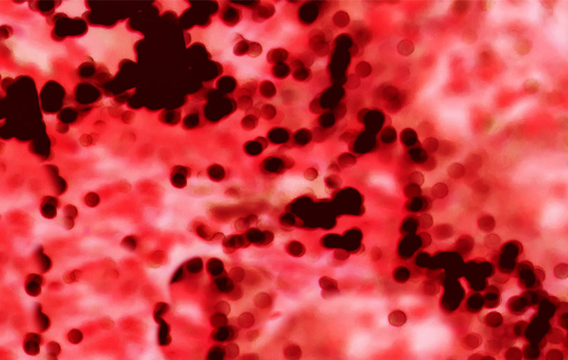 Гемобластоз: симптомы и лечение