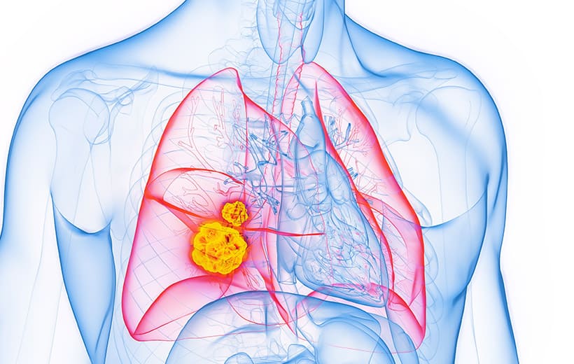 Киста легкого: причины, симптомы, лечение