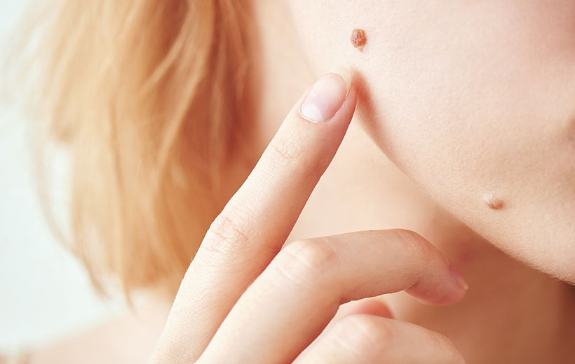 Фиброма: симптомы и лечение