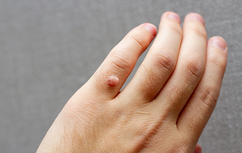 Бородавки: виды, причины, лечение Бородавки: виды, причины, лечение