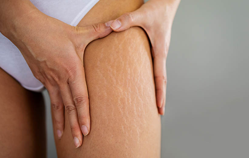 Растяжки: как избавиться от стрий