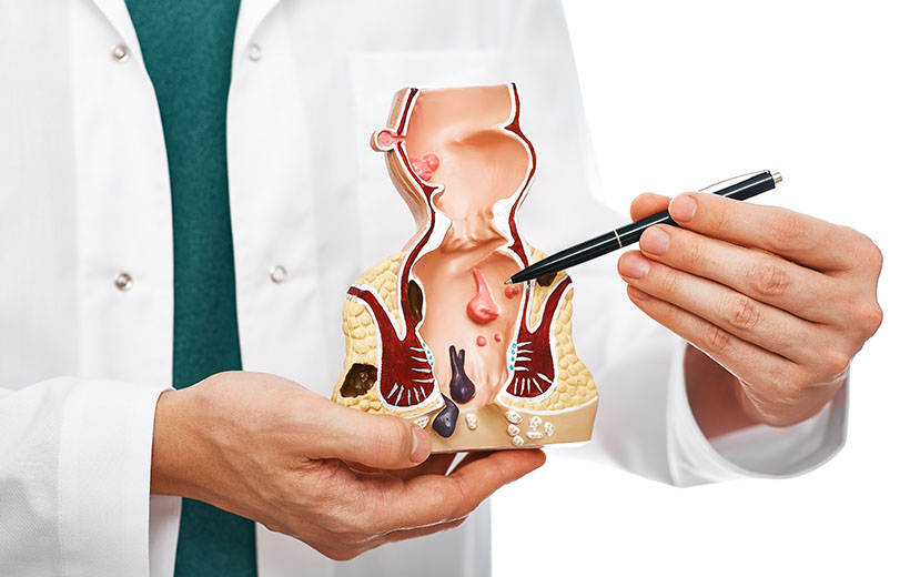 Свищ прямой кишки: причины, симптомы, лечение