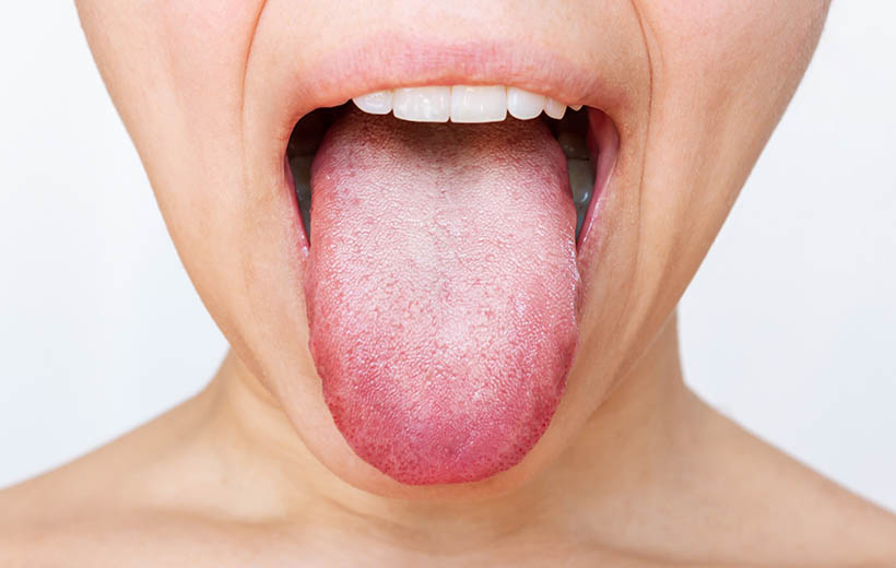 Паратонзиллярный абсцесс: симптомы и лечение