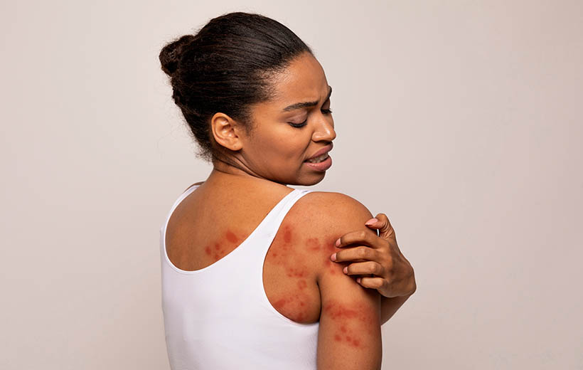 Пиодермия: симптомы и лечение