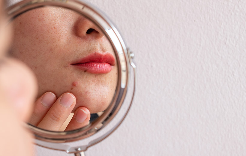 Контагиозный моллюск: симптомы и лечение у детей и взрослых