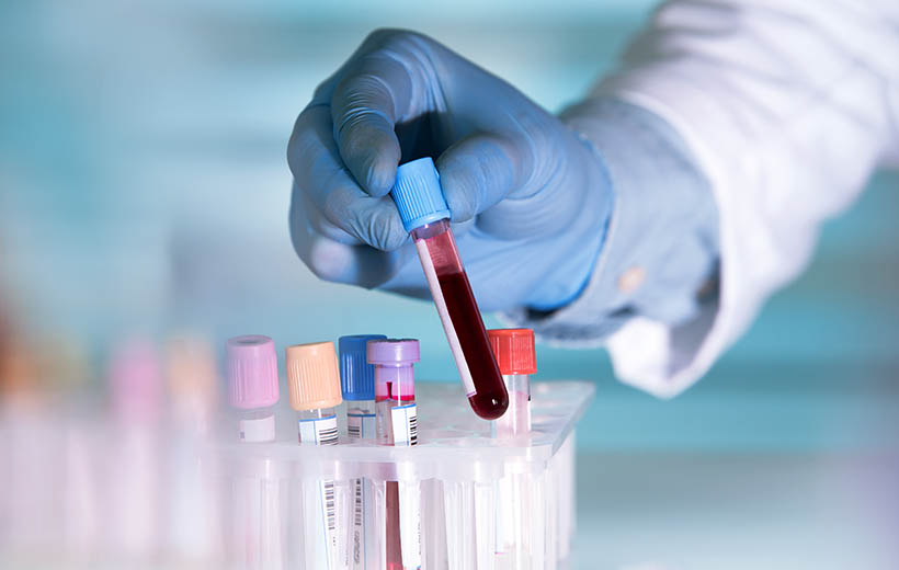 Миелодиспластический синдром: симптомы и лечение