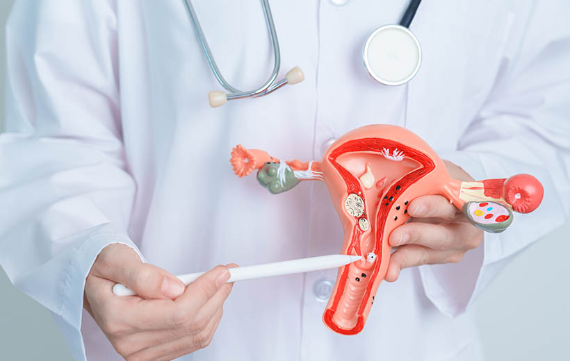 Киста шейки матки: причины, симптомы, лечение