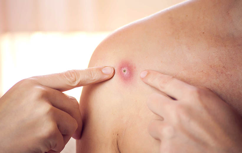 Фурункул: причины, симптомы, лечение