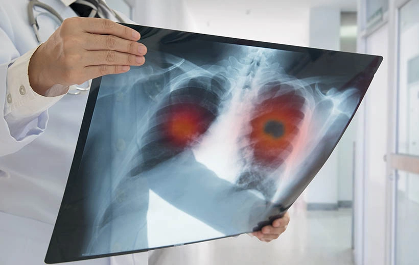 Рак легких: симптомы, стадии, лечение, прогноз