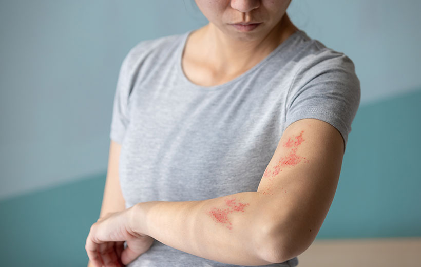 Микроспория: симптомы и лечение