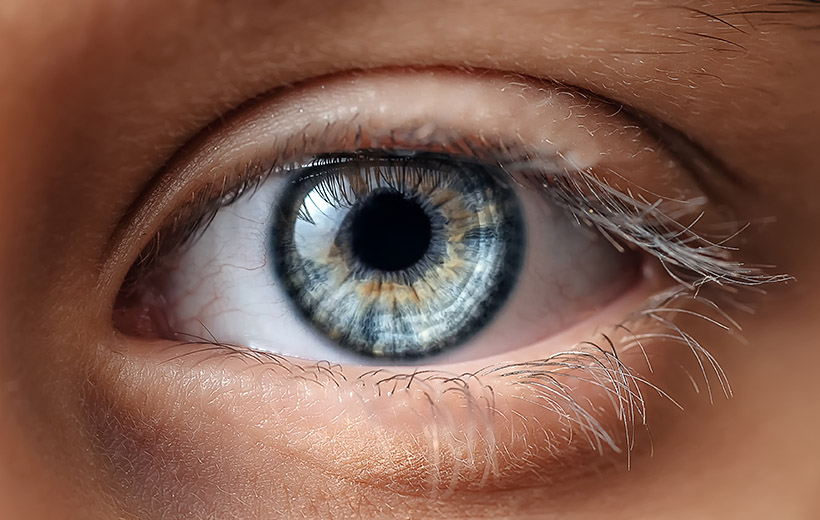 Птеригиум: причины, степени, лечение