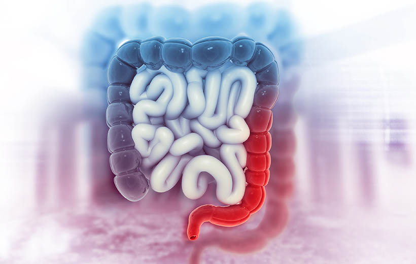 Полипы кишечника: причины, симптомы, лечение