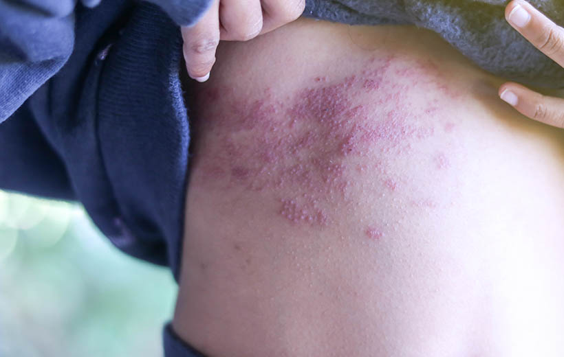 Лишай: виды, симптомы, лечение Лишай: виды, симптомы, лечение