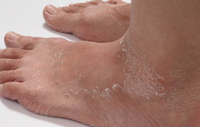 Ихтиоз: причины, формы, лечение Ихтиоз: причины, формы, лечение