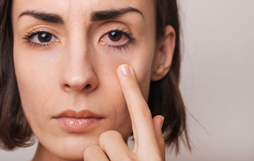 Ксантелазма: причины и лечение Ксантелазма: причины и лечение