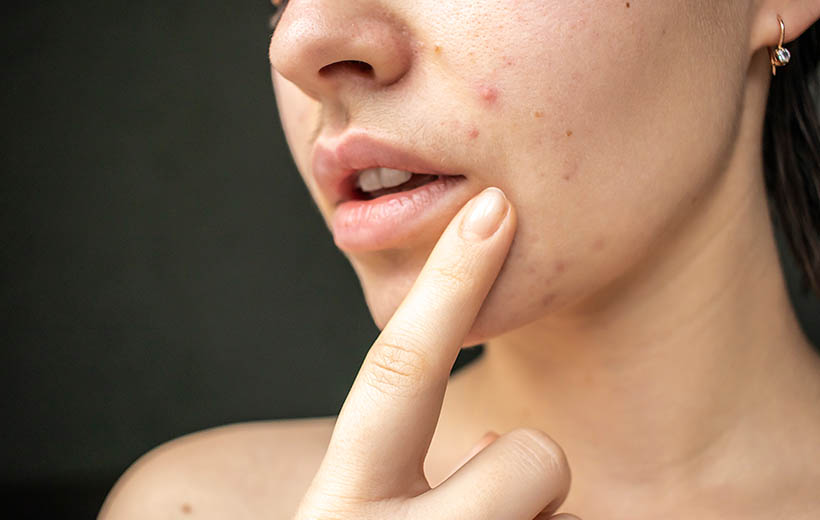 Стрептодермия: симптомы и лечение