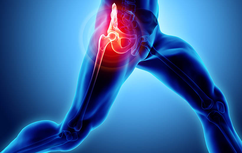 Трохантерит: симптомы и лечение Трохантерит: симптомы и лечение