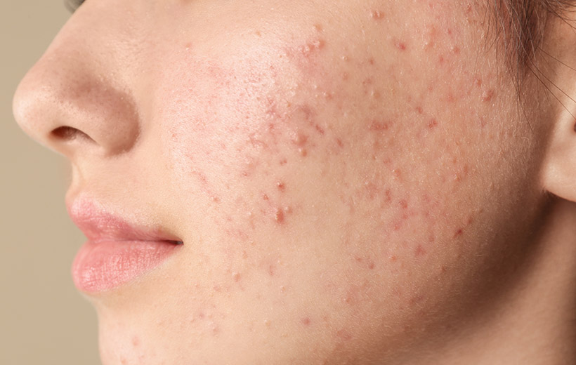 Импетиго: симптомы и лечение у детей и взрослых
