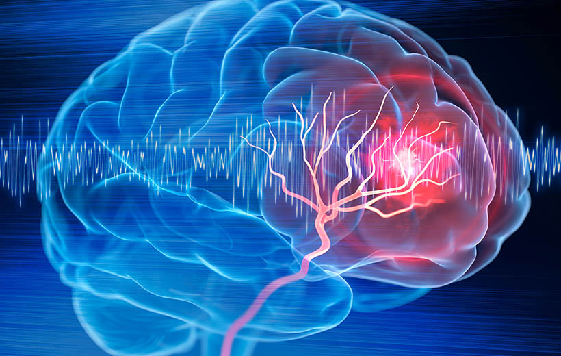 Опухоль головного мозга: симптомы, стадии, лечение
