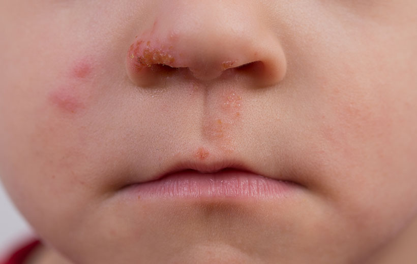 Фурункул носа: причины, стадии, лечение